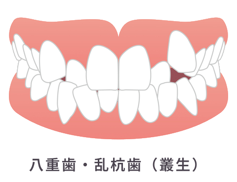 八重歯・乱杭歯（叢生）