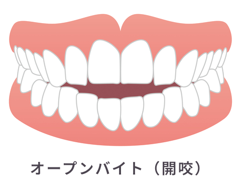 オープンバイト（開咬）