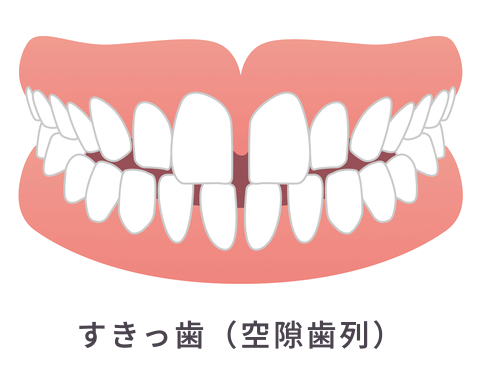 すきっ歯（空隙歯列）