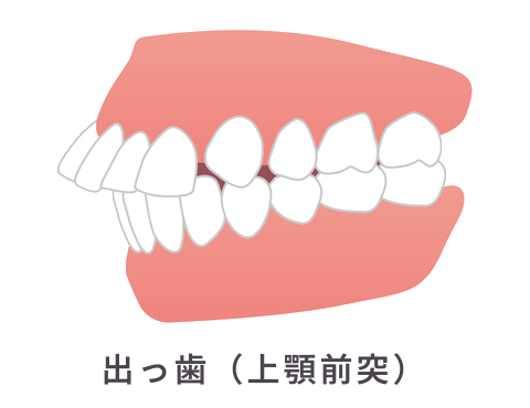 出っ歯（上顎前突）