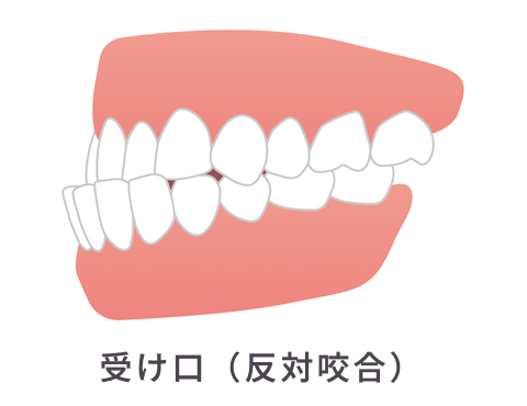 受け口（反対咬合）
