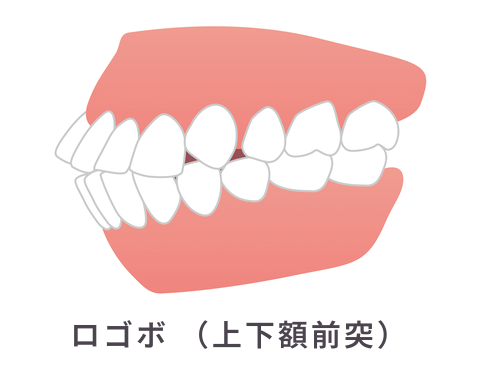 ロゴボ （上下額前突）